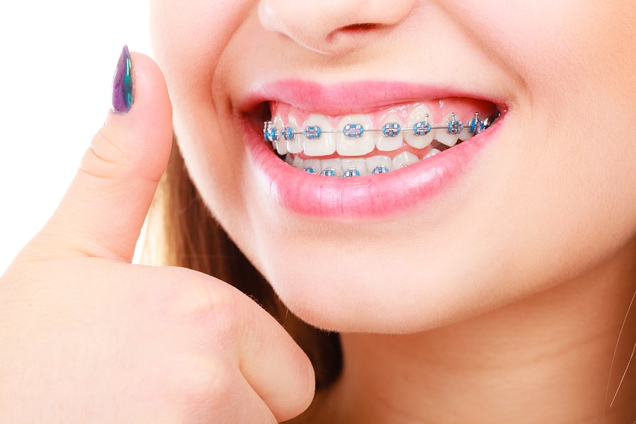 The Braces Survival Kit: What You Should Always Keep On You - My