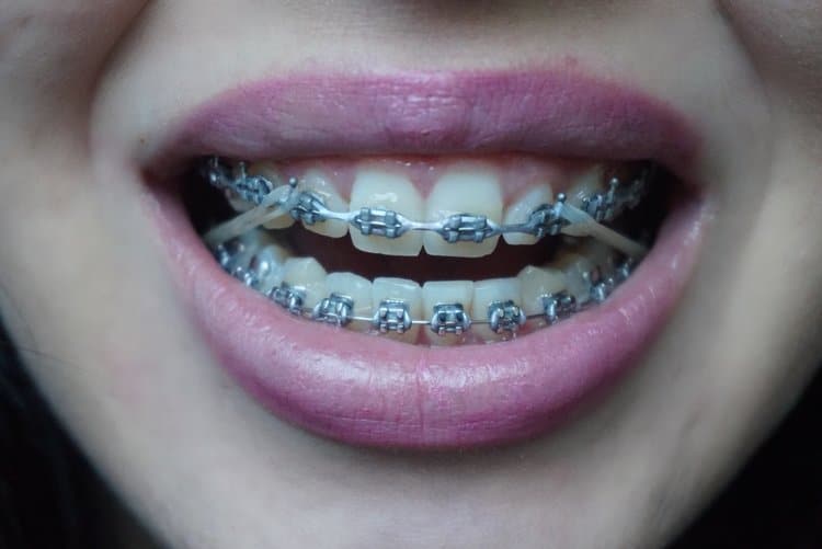 What role do elastics (rubber bands) play in Orthodontics?
