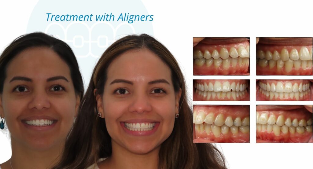 - Before and After