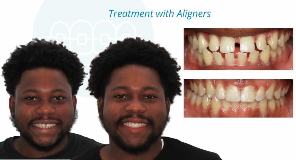 - Before and After