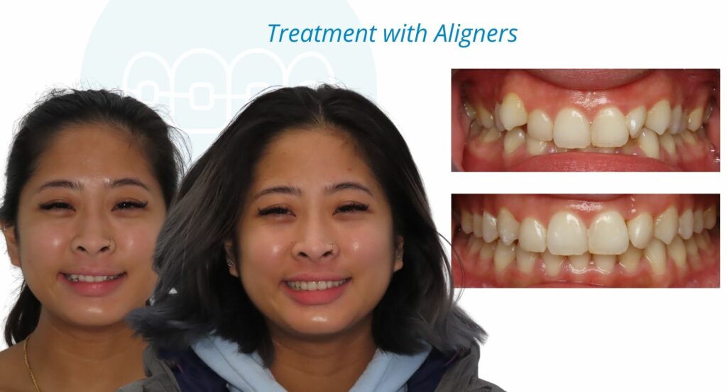 - Before and After