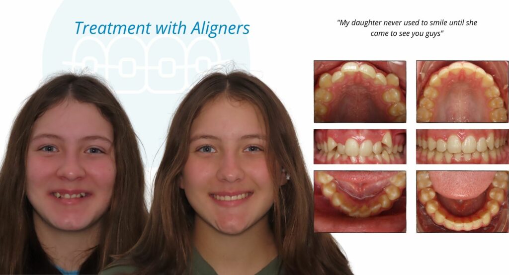 - Before and After