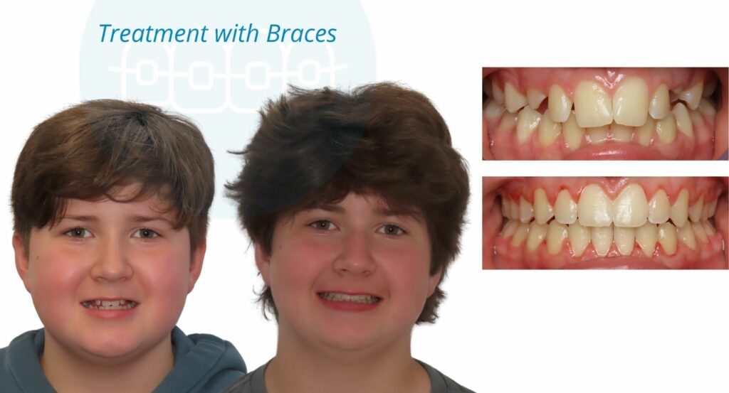 - Before and After