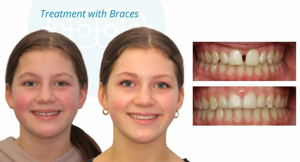 - Before and After