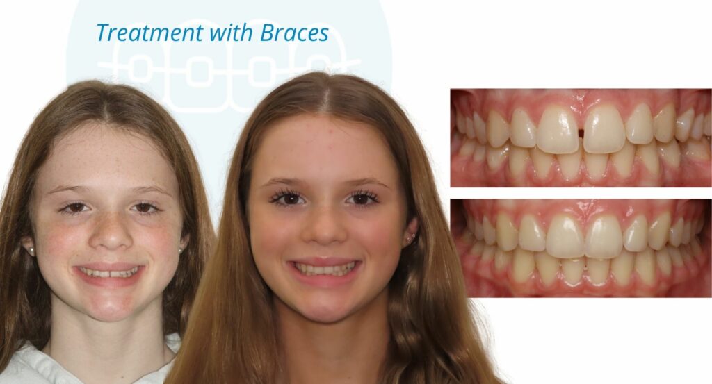 - Before and After