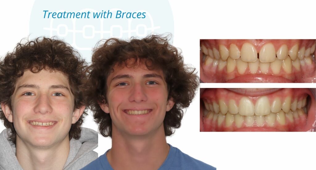 - Before and After