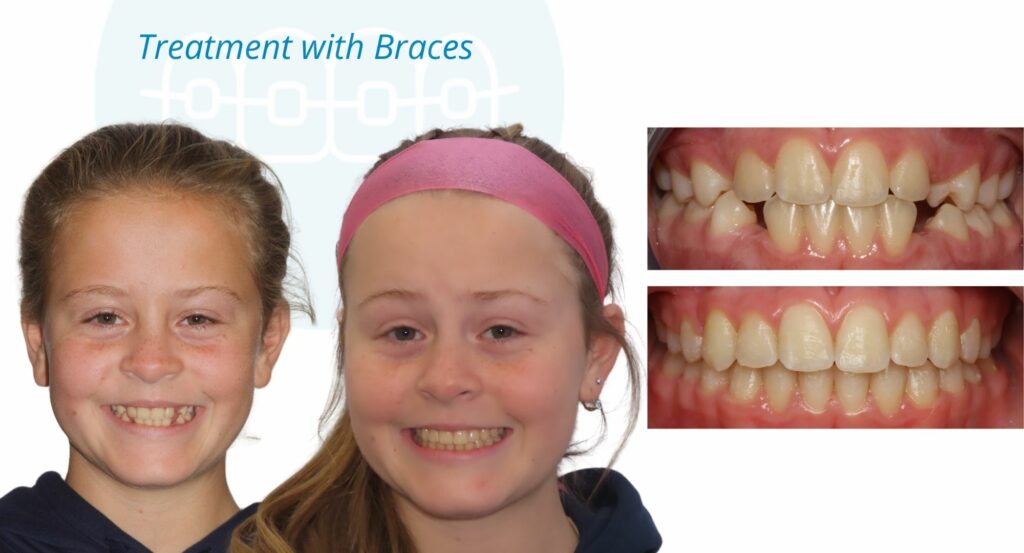- Before and After