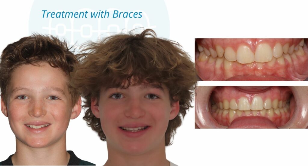 - Before and After