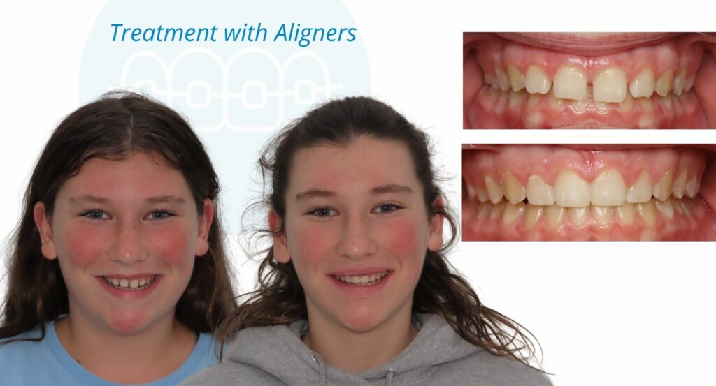 - Before and After