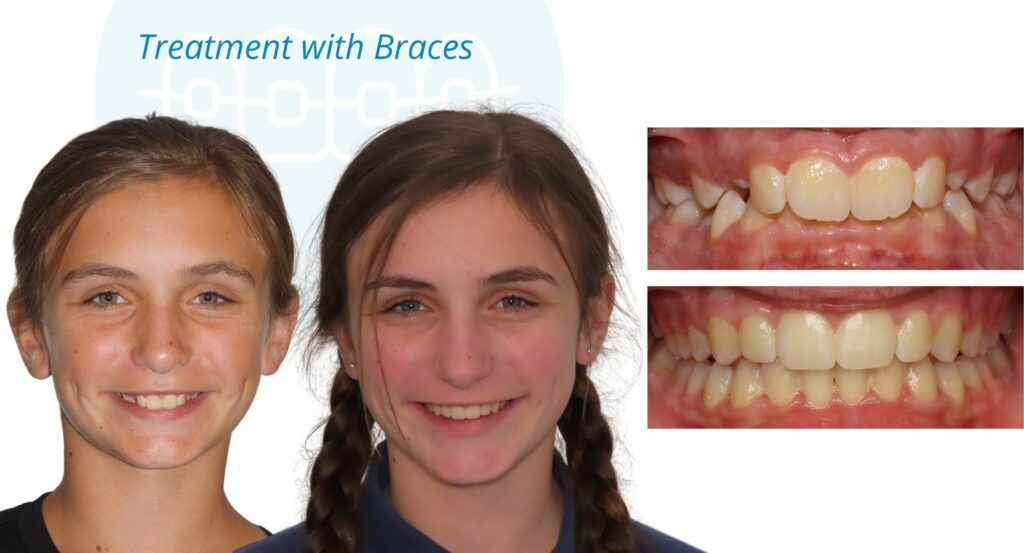 - Before and After