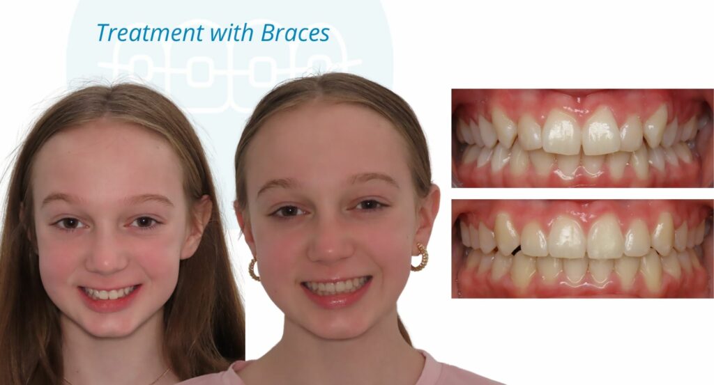 - Before and After