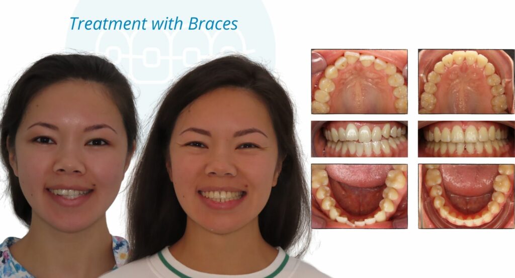 - Before and After