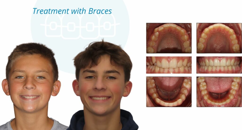 - Before and After