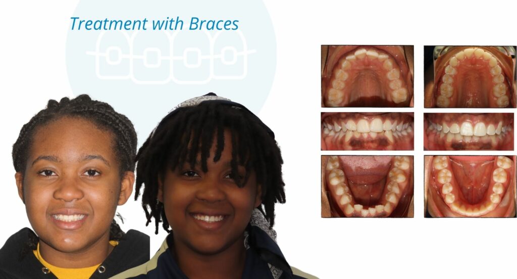 - Before and After