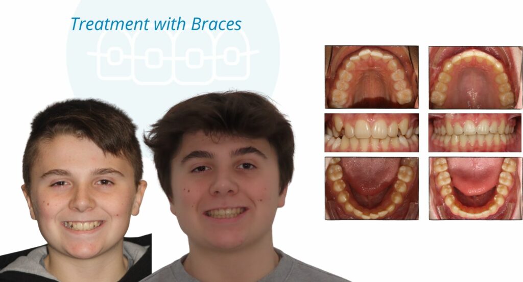 - Before and After