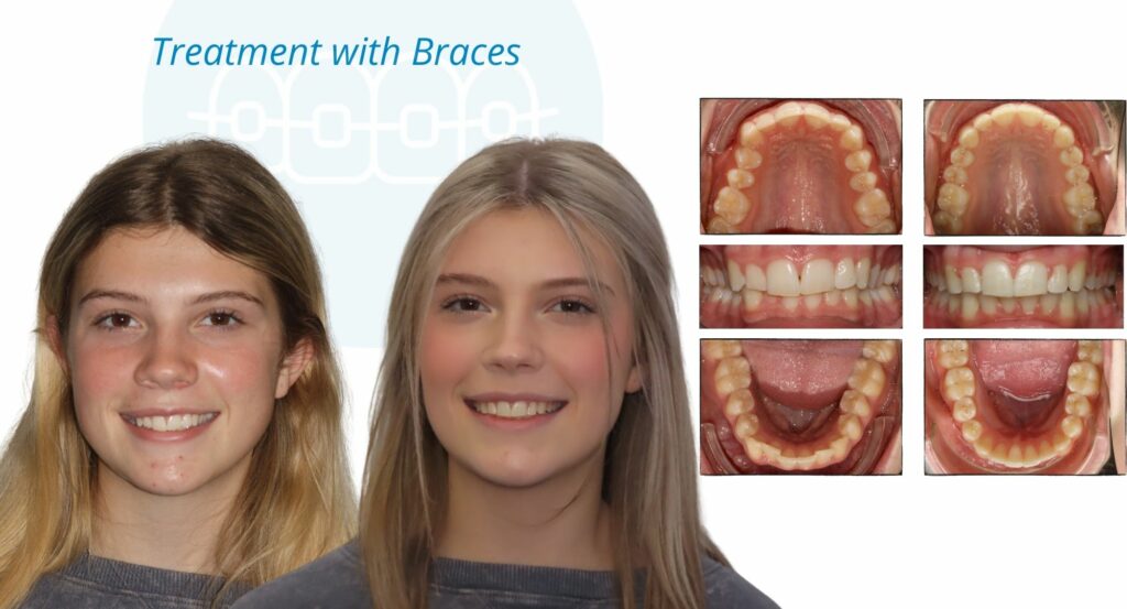 - Before and After
