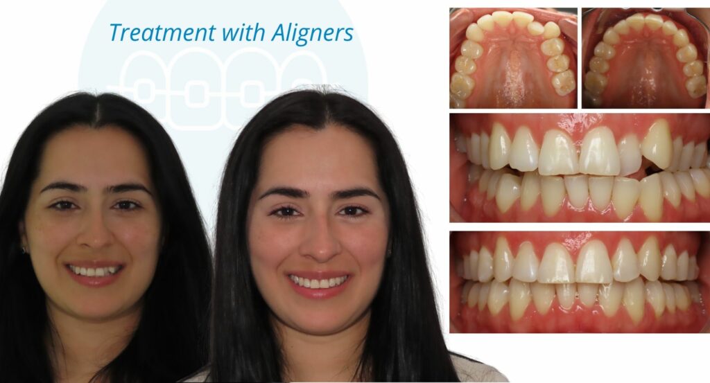 - Before and After