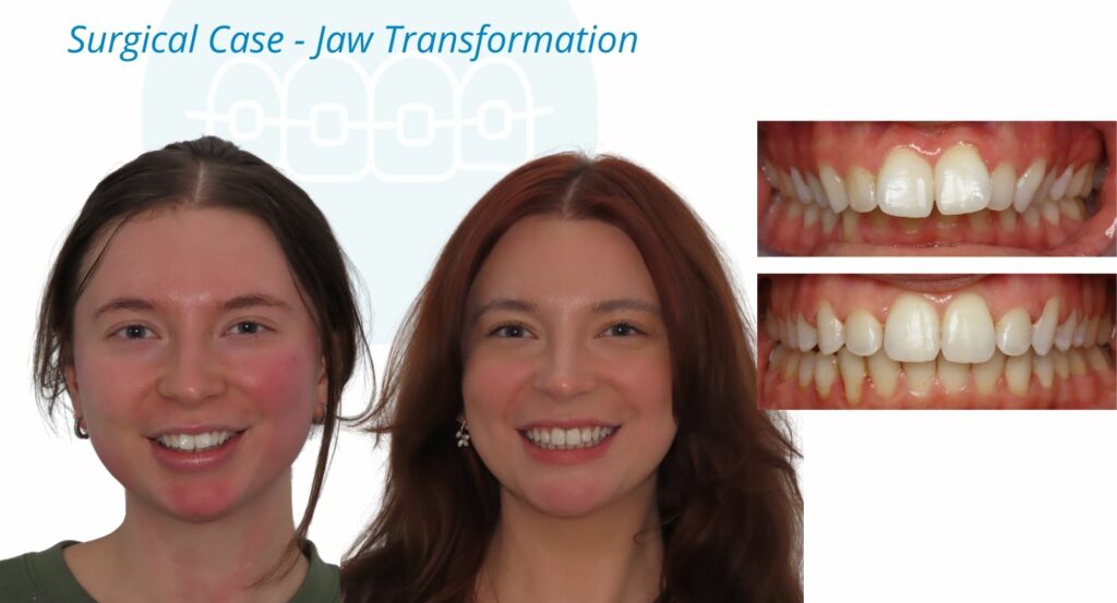 - Before and After