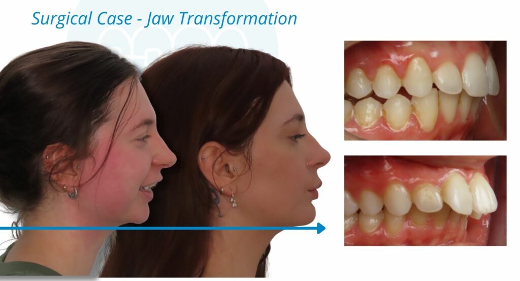 - Before and After