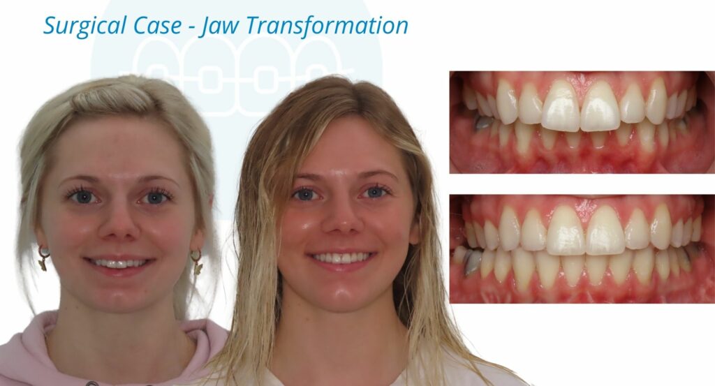 - Before and After