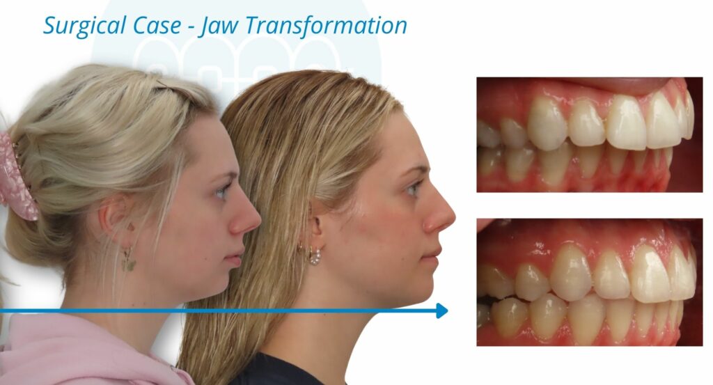 - Before and After