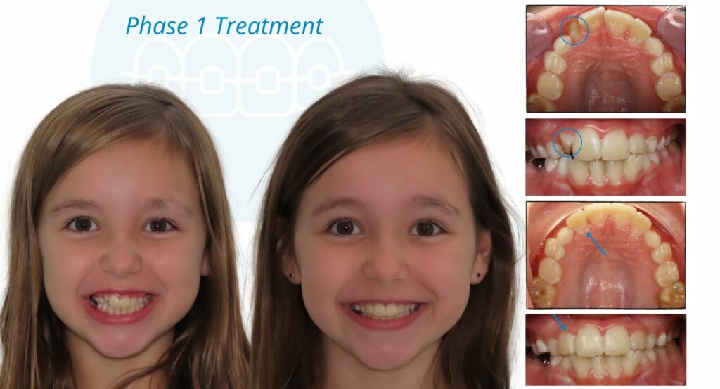- Before and After