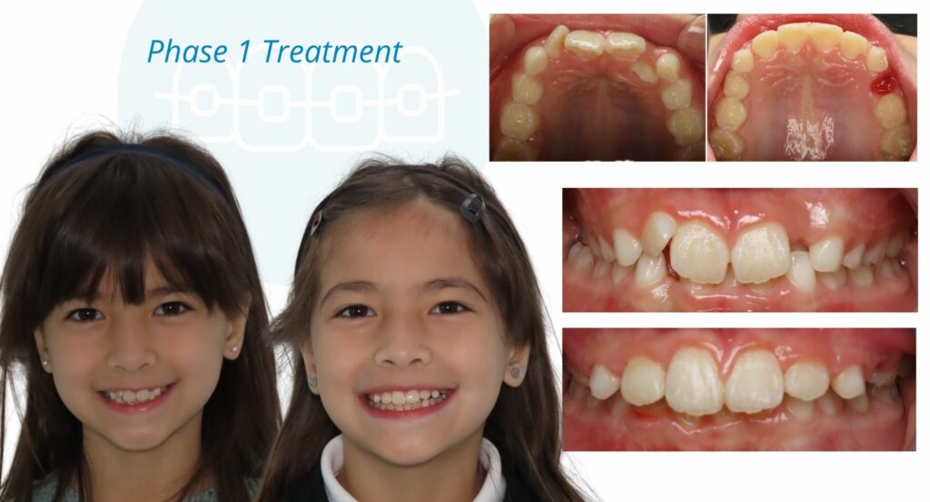 - Before and After