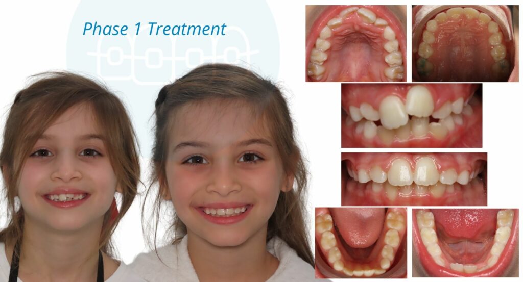 - Before and After