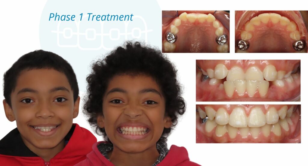 - Before and After