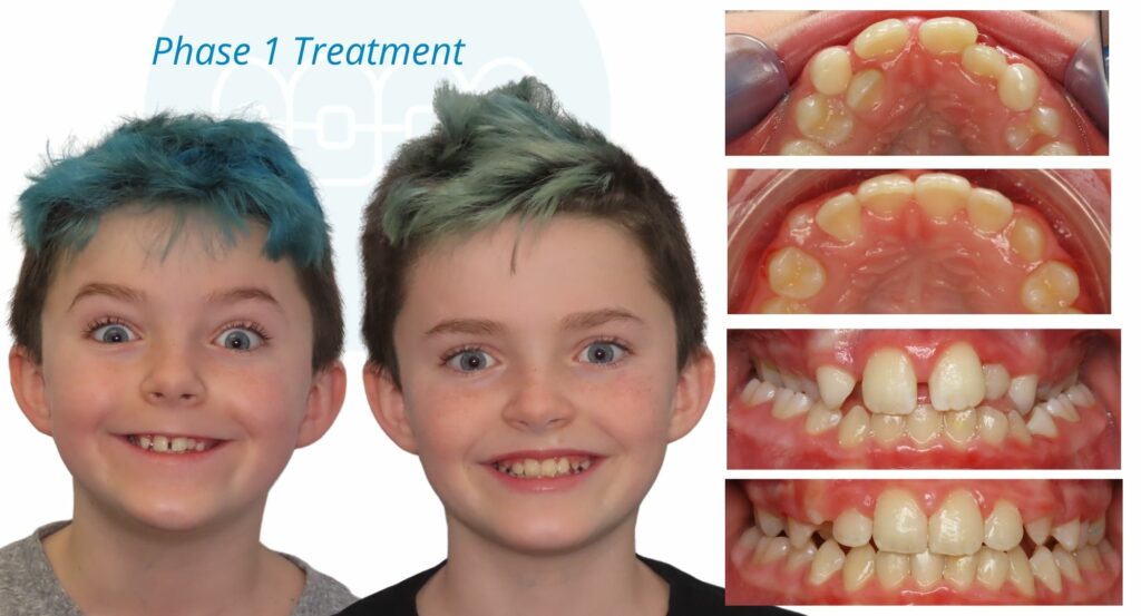 - Before and After