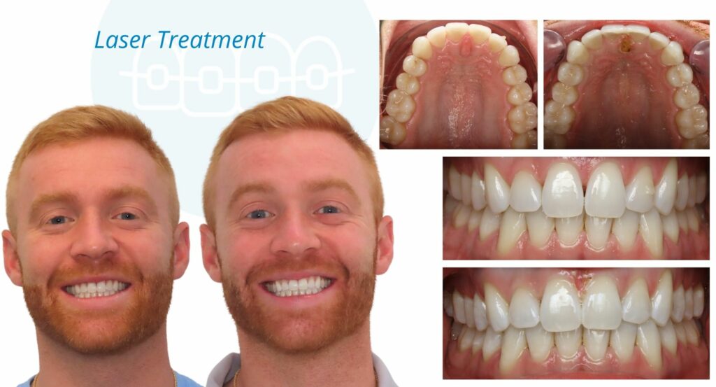 - Before and After