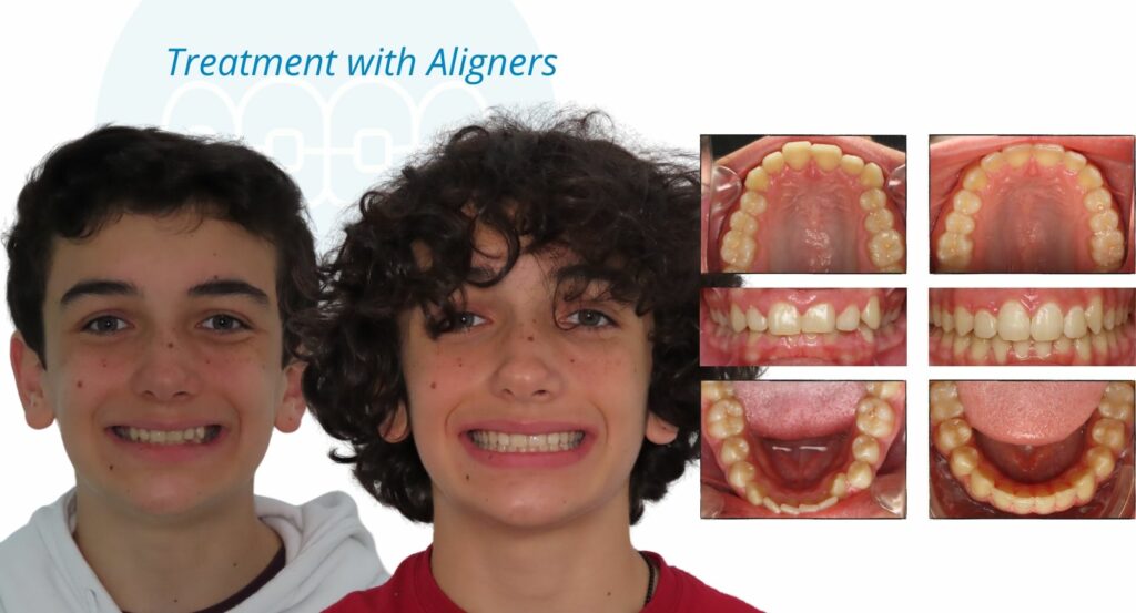 - Before and After