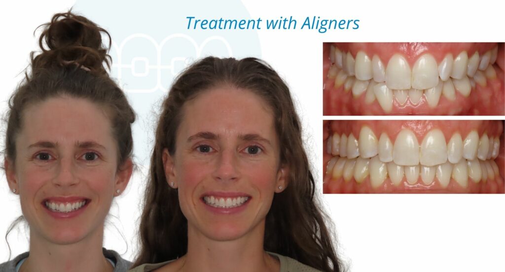 - Before and After