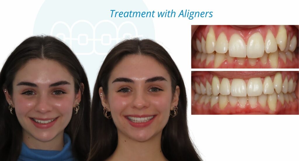 - Before and After