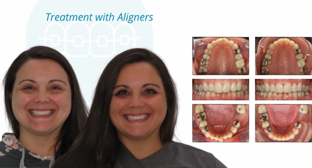- Before and After