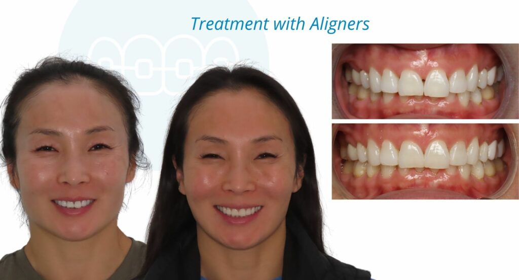 - Before and After