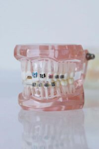 colored braces