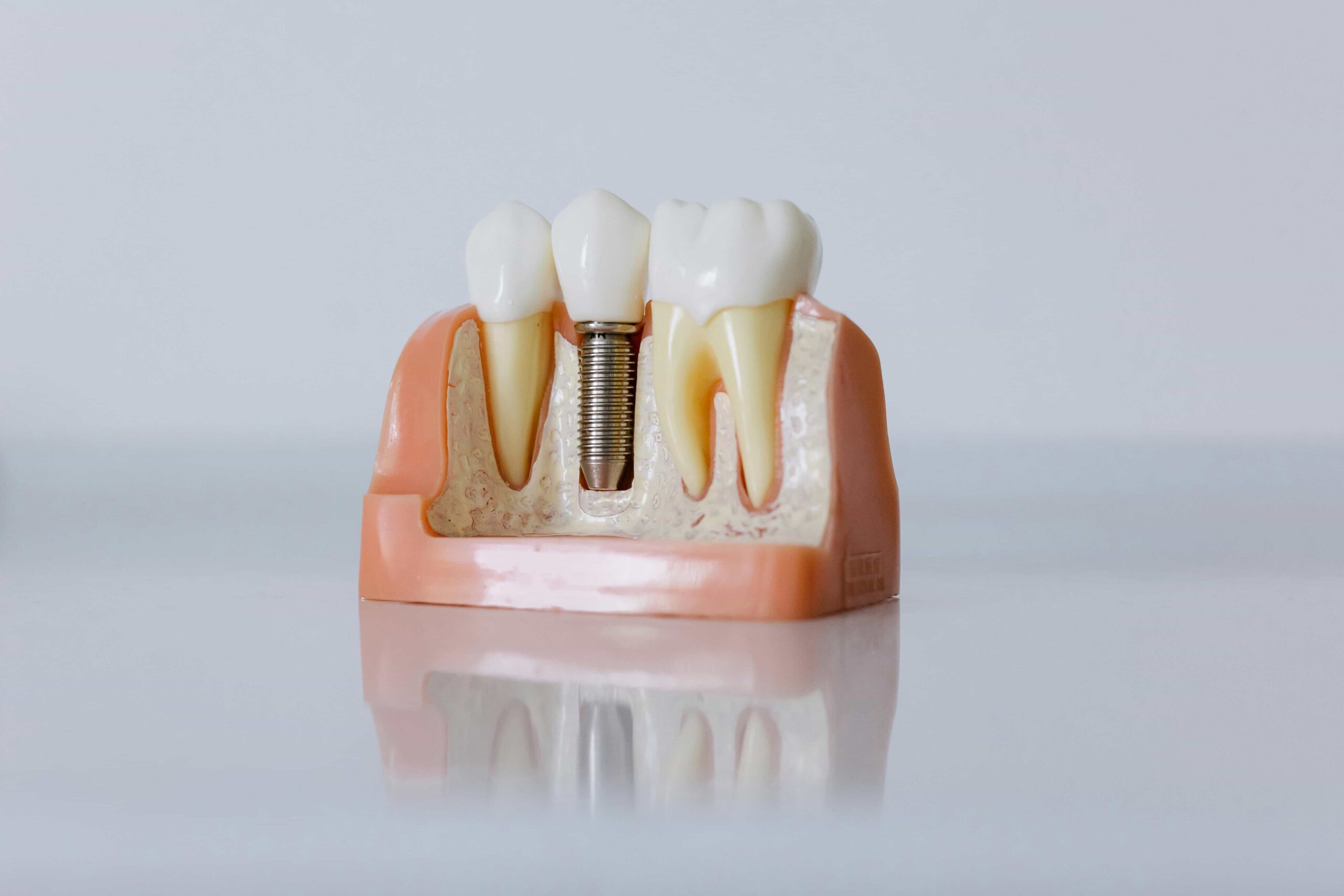 tooth model with replacement